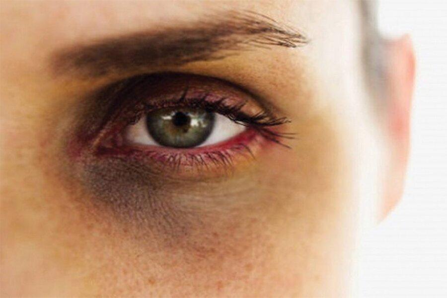 روش های طبیعی برای بهبود حلقه های سیاه دور چشم
