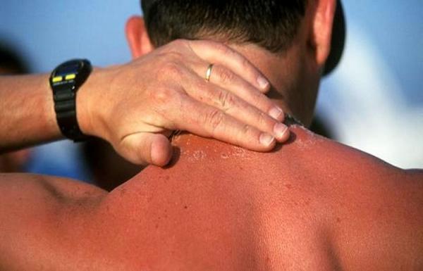 کدام قسمت های بدن از آفتاب سوختگی مصون نمی مانند؟