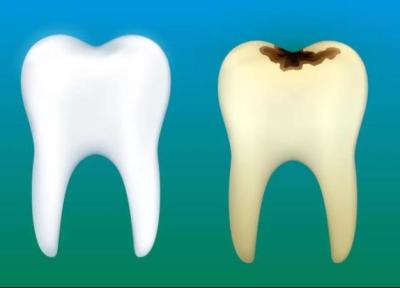 درمان پوسیدگی دندان به روش طب سنتی