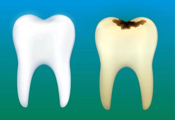 درمان پوسیدگی دندان به روش طب سنتی